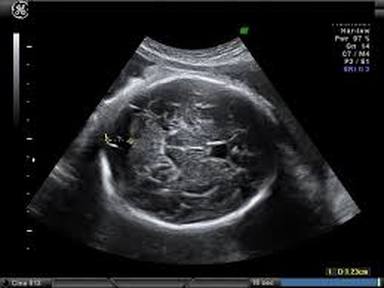 Diagnosis of Cranial Conditions with Neurosonography - An Ultrasound  technician